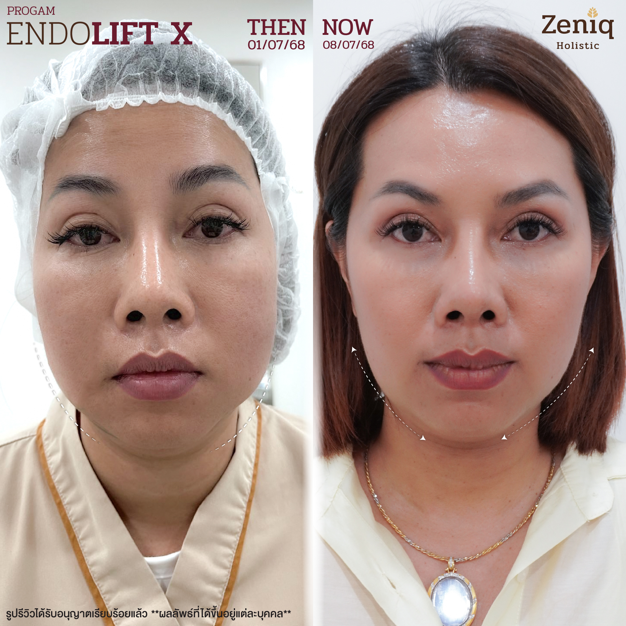 รีวิวลูกค้าคลินิกความงาม Zeniq Holistic