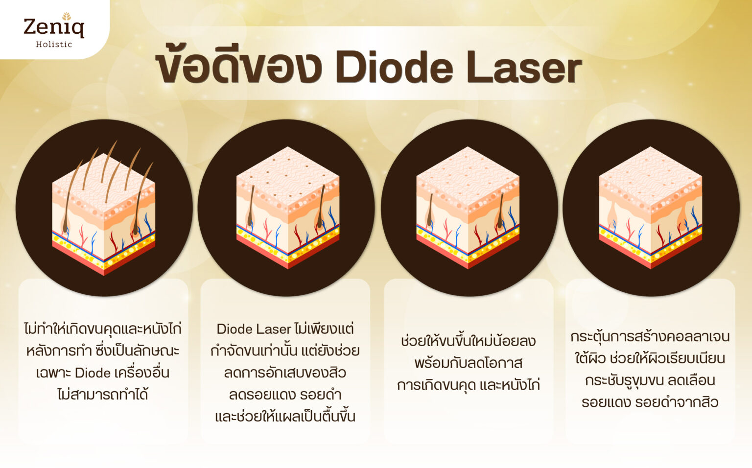 ข้อดีของการกำจัดขนด้วย diode laser