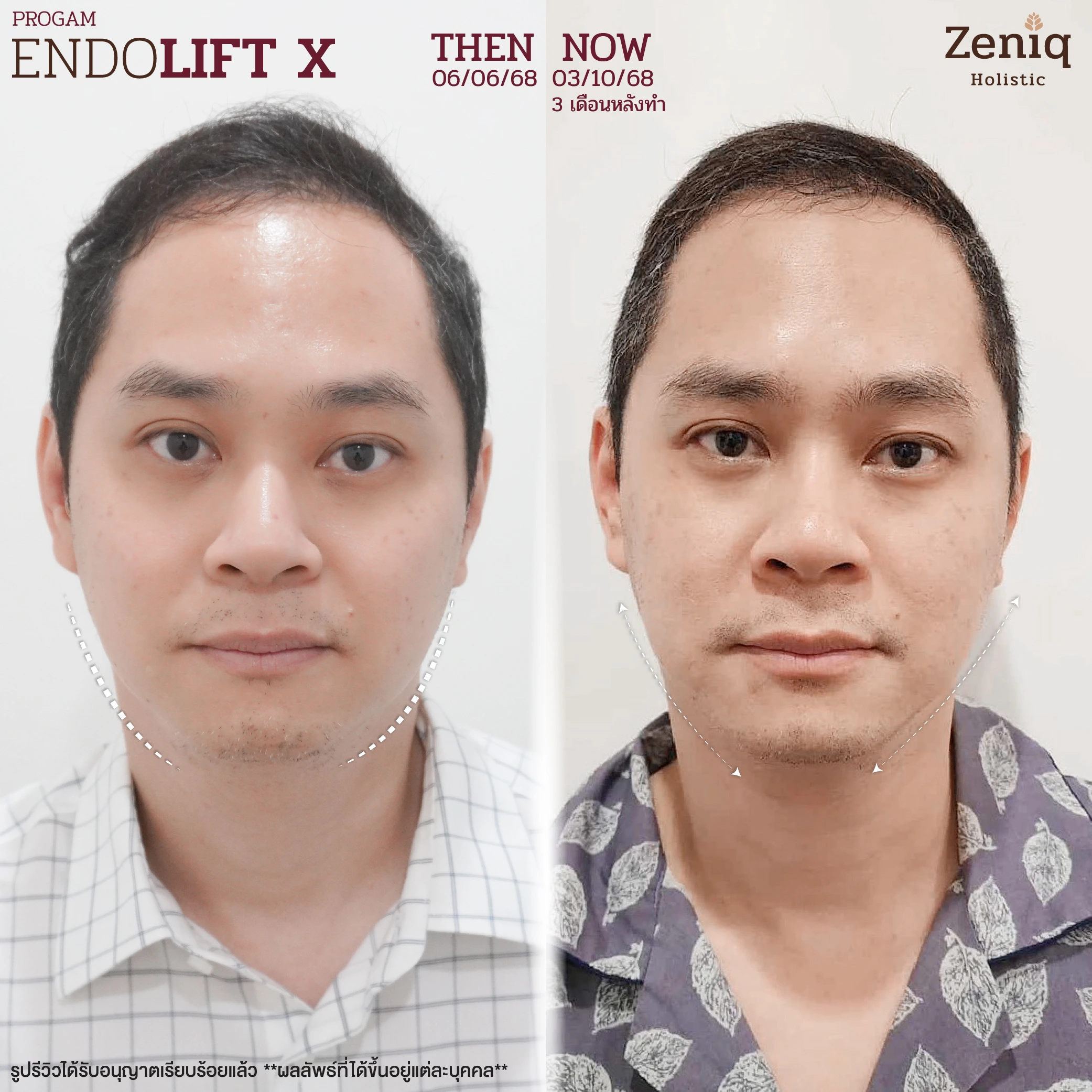endolift-review-02