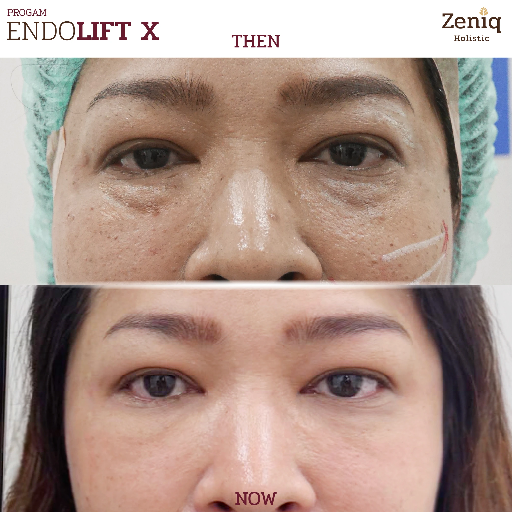 endolift-review-03