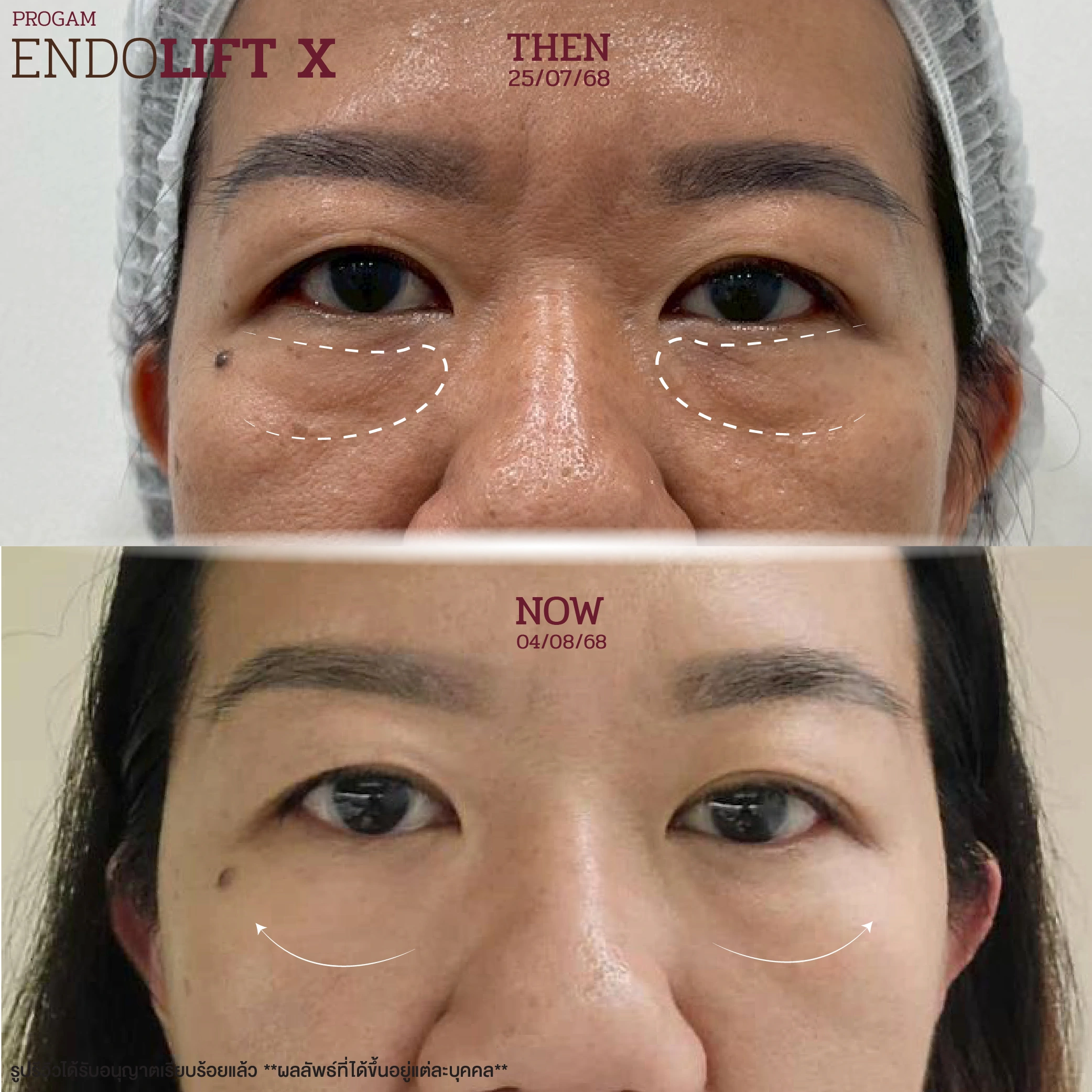 endolift-review-05