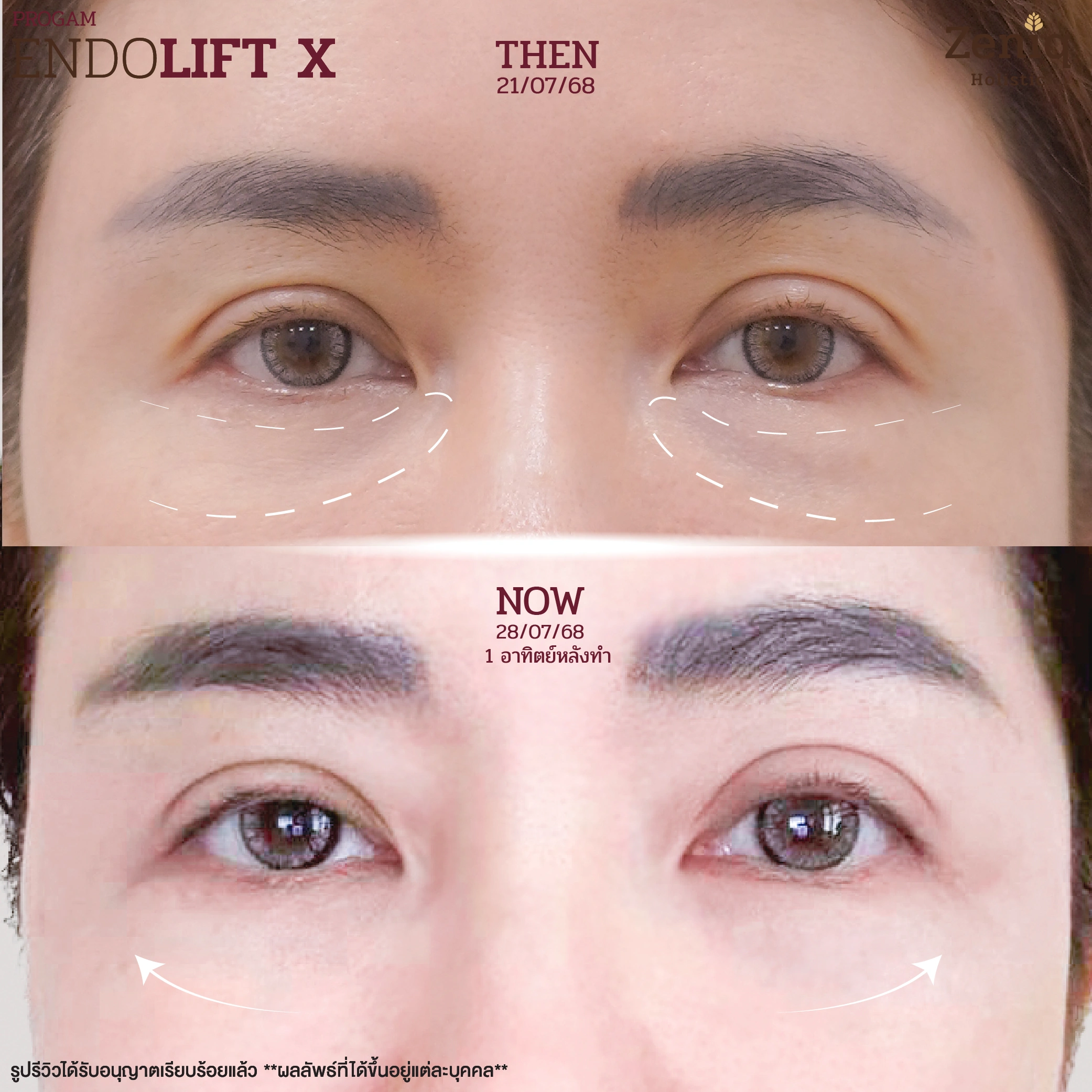 endolift-review-06