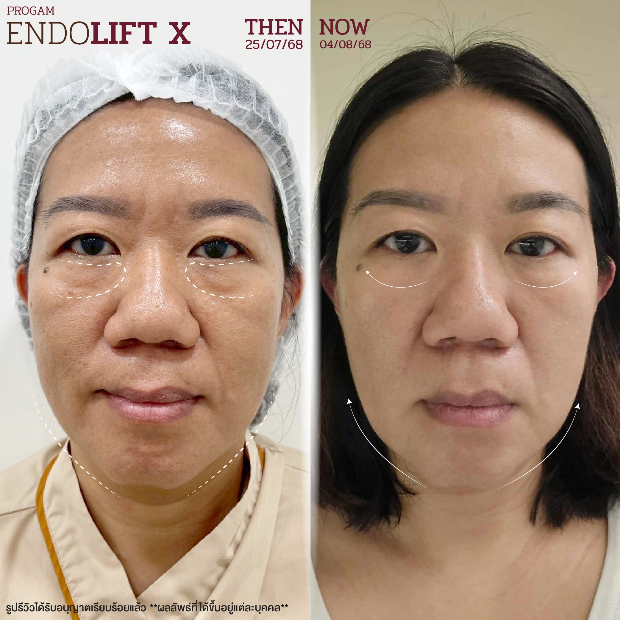 endolift-review-07